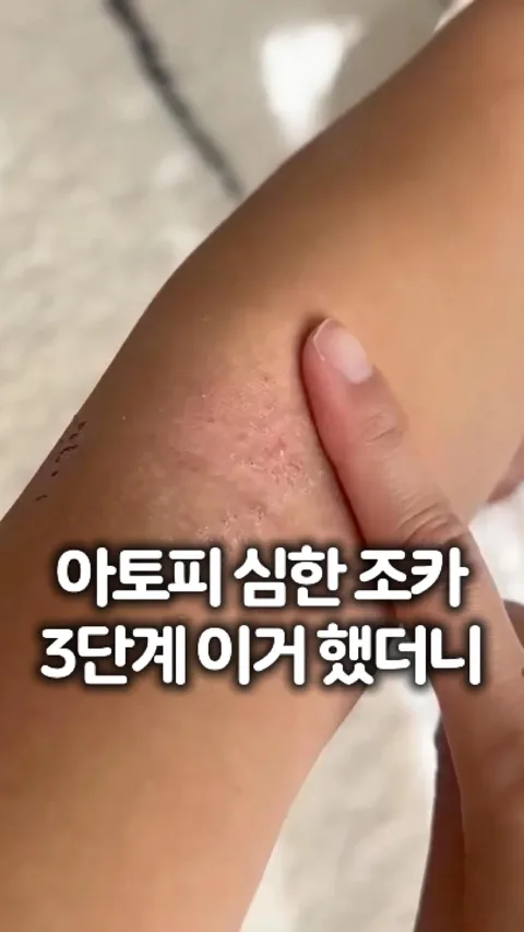 154 아토피 심한 조카 3단계 이거 했더니