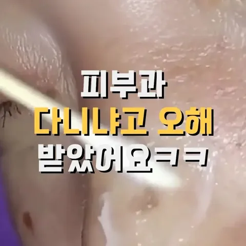 ♥️ 기미 제거 크림